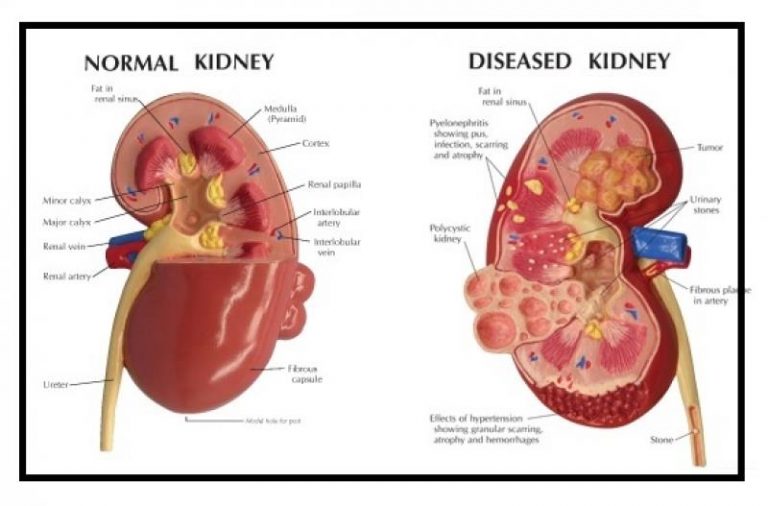 Kidney Failure Treatment In Delhi India